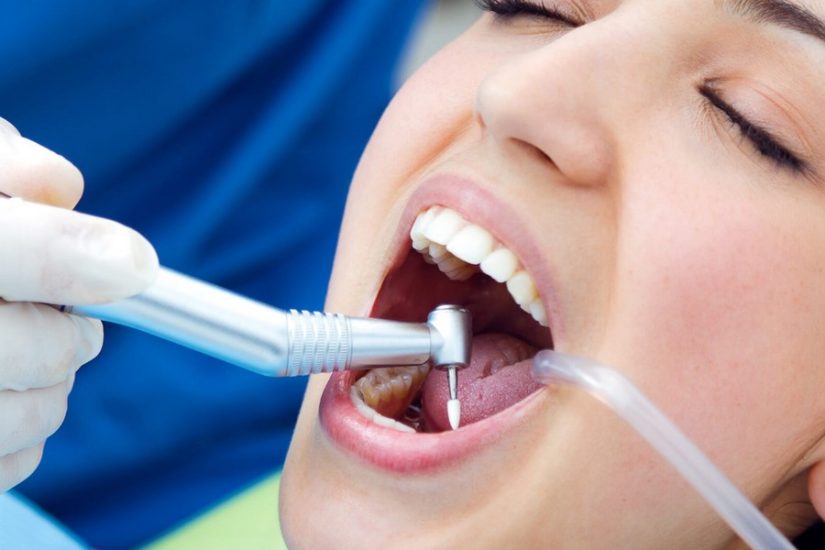Things to Know Before Getting a Tooth Filling Done